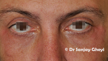 Teat Trough after treatment with dermal fillers